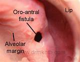 Oral Fistula Treatment Images