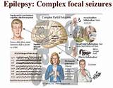 Complex Partial Seizure Disorder Treatment Images