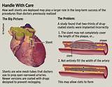How Do Doctors Put Stents In Heart