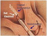 Ablation Uterus Recovery