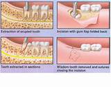 Images of What Can I Take For Wisdom Tooth Pain