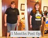 Pictures of Gas After Gastric Sleeve