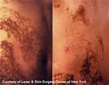 Pictures of Laser Skin Treatment Nyc