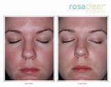 Metronidazole Gel Rosacea Side Effects Pictures