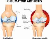 Pictures of Rheumatoid Arthritis Ice Or Heat