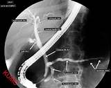 Images of What Is A Ercp Medical Procedure
