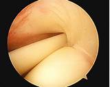 Pictures of Recovery From Biceps Tenodesis Arthroscopy Surgery