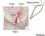 Pictures of Endometrial Biopsy Recovery