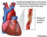 What Can Cause Coronary Artery Disease Pictures