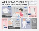 Atopic Dermatitis Medications Treatment Images