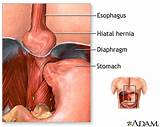 Pictures of Hiatal Hernia Doctor