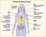 Pictures of Psychological Treatment For Bulimia Nervosa