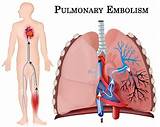 Medical Treatment For Pulmonary Embolism Photos