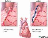 Pictures of Cabg Recovery