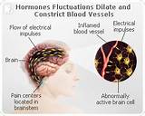 Pictures of Menopause Migraines Treatment