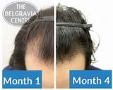 Images of Widows Peak Hair Loss Treatment