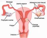 Fallopian Tubes Blocked Test Photos