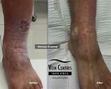 Venous Eczema Treatment Pictures