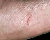 Photos of Scabies Doctor