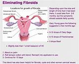 Recovery After Fibroid Surgery Pictures