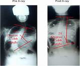 Photos of Cobb Angle Scoliosis Treatment