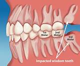 What Can I Take For Wisdom Tooth Pain Pictures