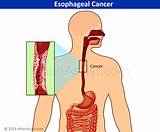 Pictures of Chemotherapy And Radiation Therapy For Esophageal Cancer