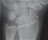 Scaphoid Fracture Treatment Options Pictures