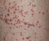Images of Vitamin C Dark Spot Removal