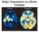 Images of Clinical Depression Symptoms