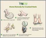 Pictures of Why Cracked Heels