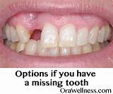 Images of How Do You Get Silver Teeth