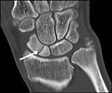 Scaphoid Fracture Treatment Options Pictures