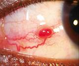 Photos of Conjunctival Pyogenic Granuloma Treatment