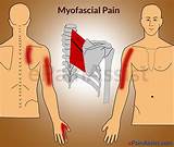 Photos of Myofascial Pain Syndrome Treatment