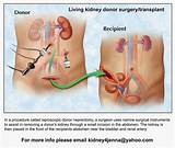 Kidney Donor Surgery Recovery Time