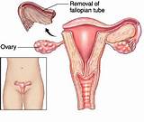 Recovery After Fallopian Tube Removal Photos