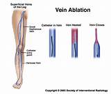 Ablation Recovery Period Images