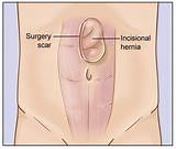 Hernia Surgery Recovery Symptoms Images