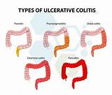 Pictures of Ulcerative Colitis Joint Pain Treatment