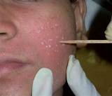 Treatments For Ice Pick Acne Scars Images