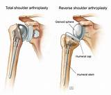 Partial Shoulder Replacement Recovery Images