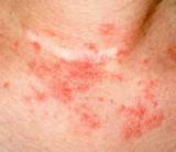 Photos of Eczema Treatment During Pregnancy