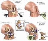 Hamstring Repair Recovery Images