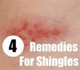 Any Home Remedies For Shingles Photos