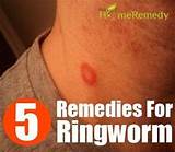 Pictures of Home Remedies Ringworm Dogs