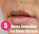 Fast Home Remedies For Fever Blisters Photos