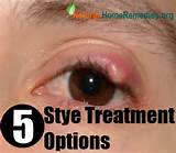 Images of Home Remedies For Styes On Upper Eyelid
