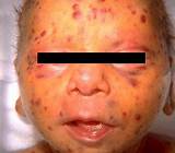 German Measles Home Remedies