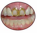 Pictures of Gold Teeth Dentures